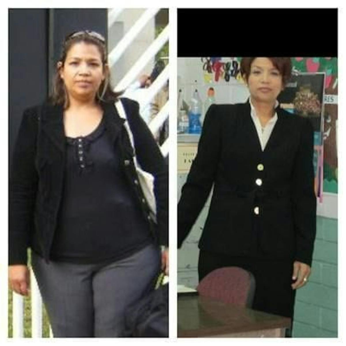 Bariatric Surgery Before & After Gallery - Patient 374476 - Image 1
