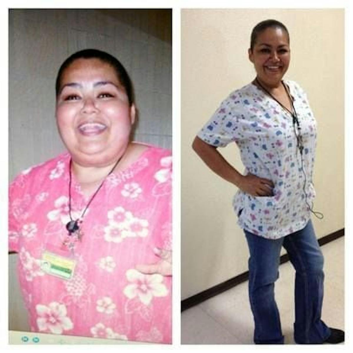 Bariatric Surgery Before & After Gallery - Patient 238213 - Image 1