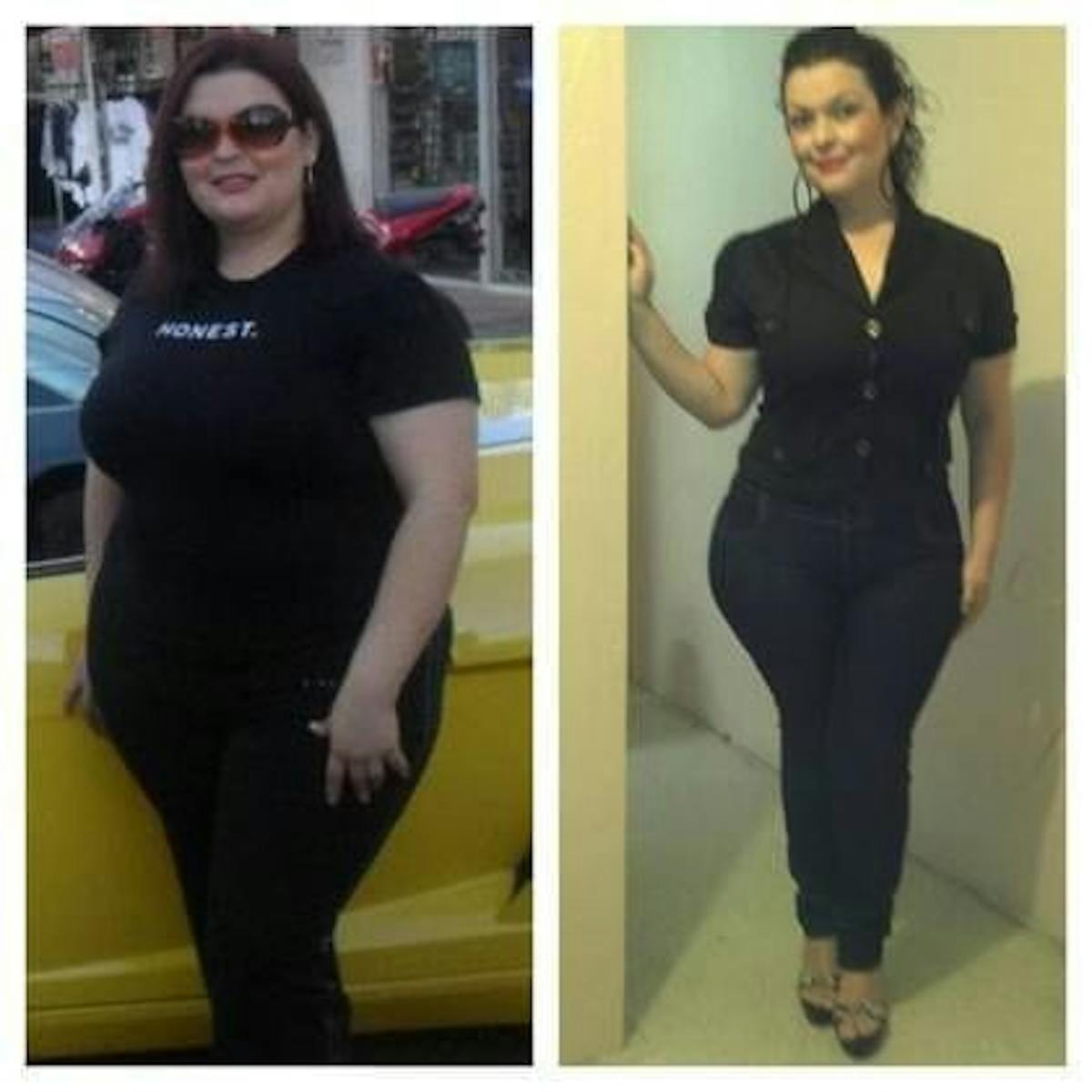 Bariatric Surgery Before & After Gallery - Patient 569127 - Image 1