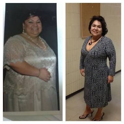 Bariatric Surgery Before & After Gallery - Patient 240349 - Image 1