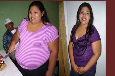 Bariatric Surgery Before & After Gallery - Patient 118442 - Image 1