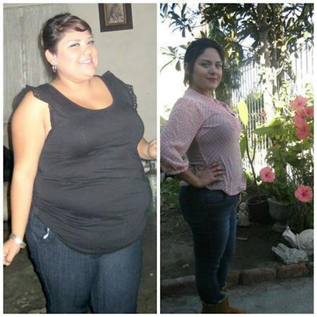 Bariatric Surgery Before & After Gallery - Patient 428470 - Image 1