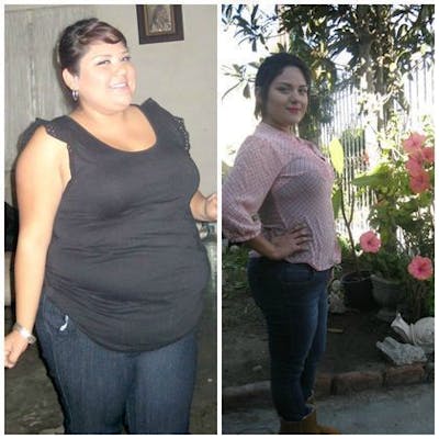 Bariatric Surgery Before & After Gallery - Patient 428470 - Image 1