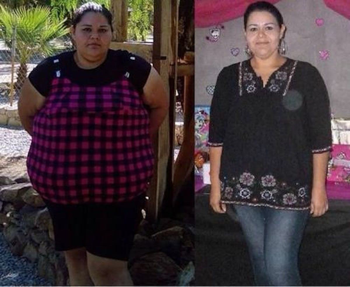 Bariatric Surgery Before & After Gallery - Patient 135659 - Image 1