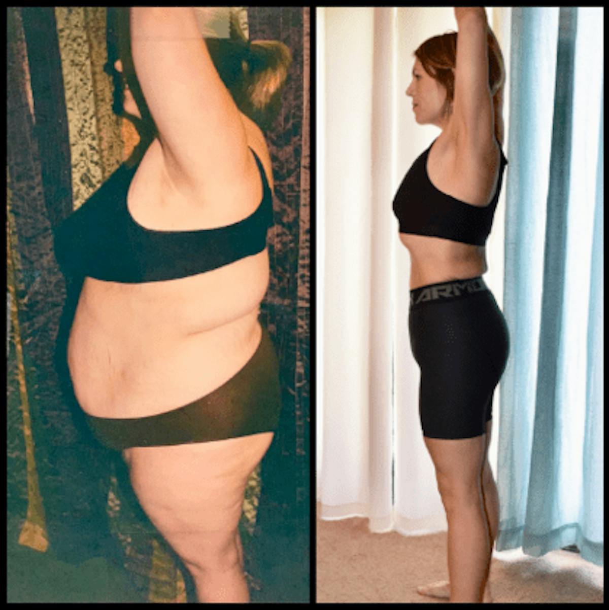 Bariatric Surgery Before & After Gallery - Patient 150398 - Image 1