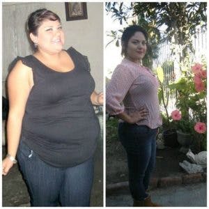 beautiful lady before and after gastric sleeve surgery