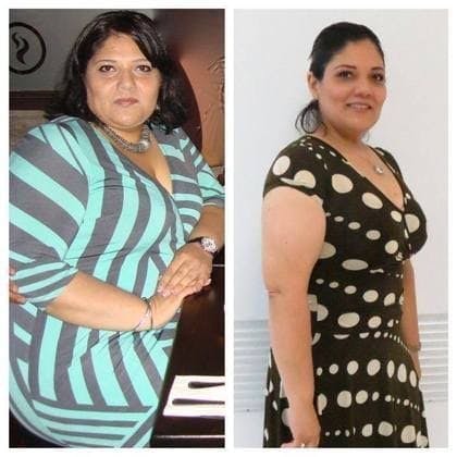 pretty lady before and after revision bariatric surgery