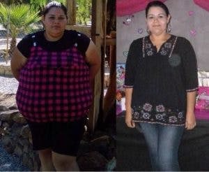 Obese lady before and after gastric bypass surgery