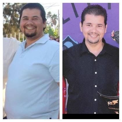 man before and after mini gastric bypass surgery