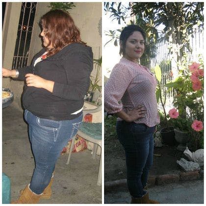 young lady before and after weight loss surgery