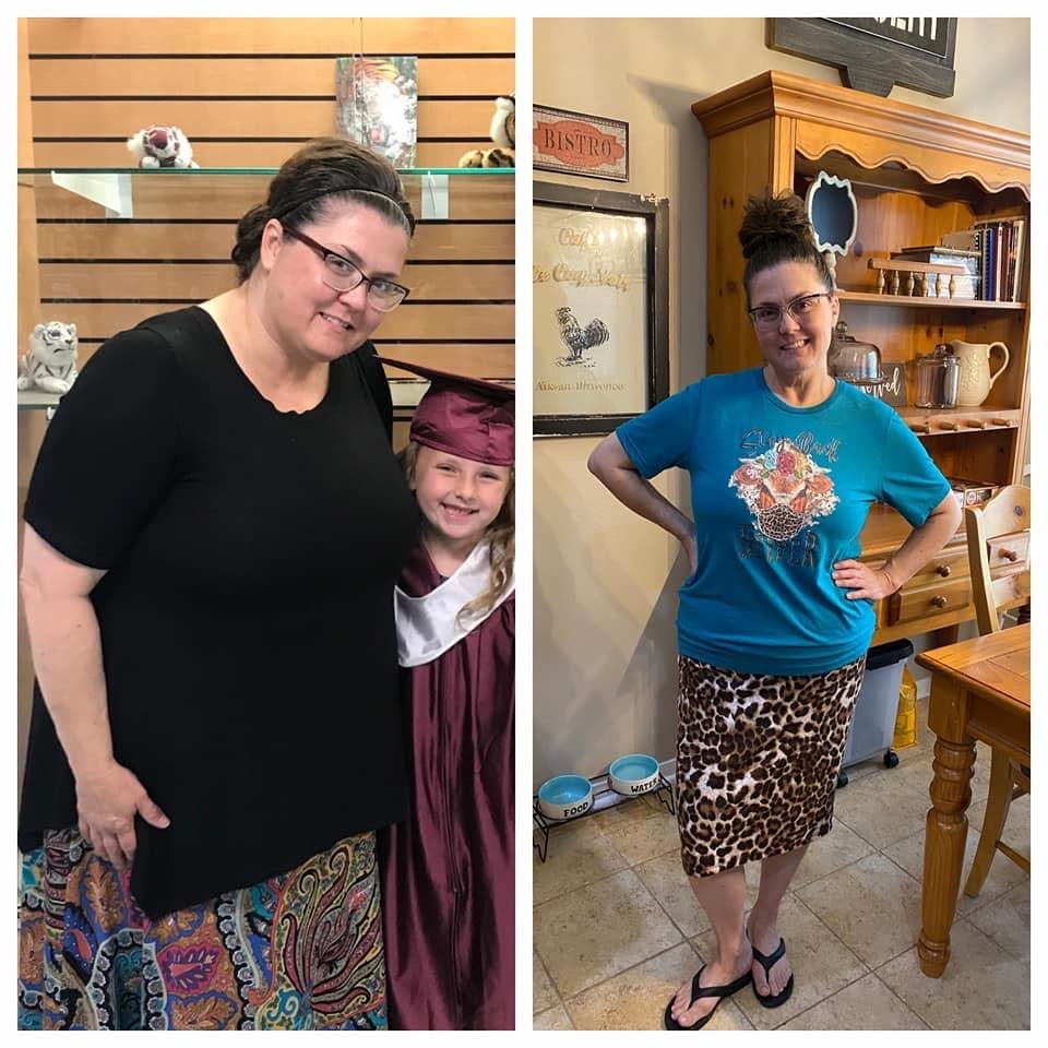 bariatric surgery - lady before and after 2