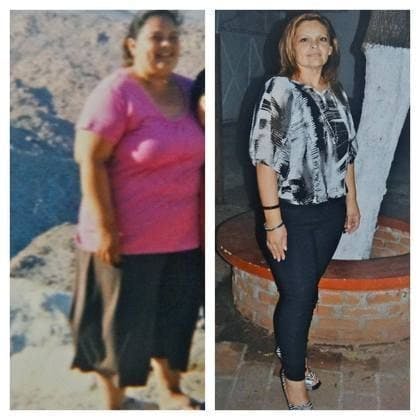 lady before and after gastric bypass surgery