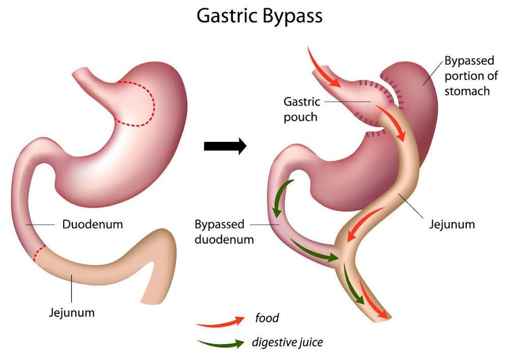 What is Gastric Bypass Surgery