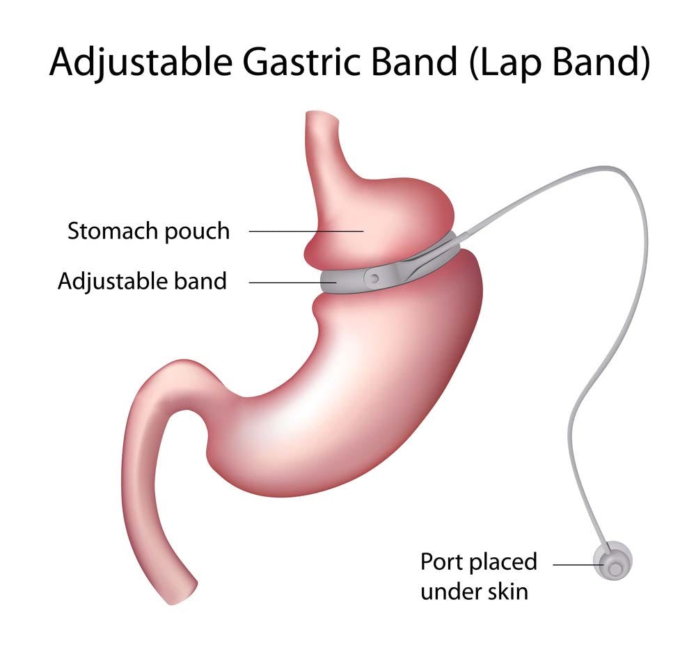 What is a Gastric Band