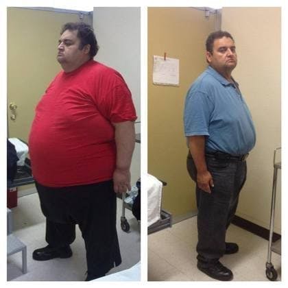 tubby man before and after gastric sleeve plication surgery