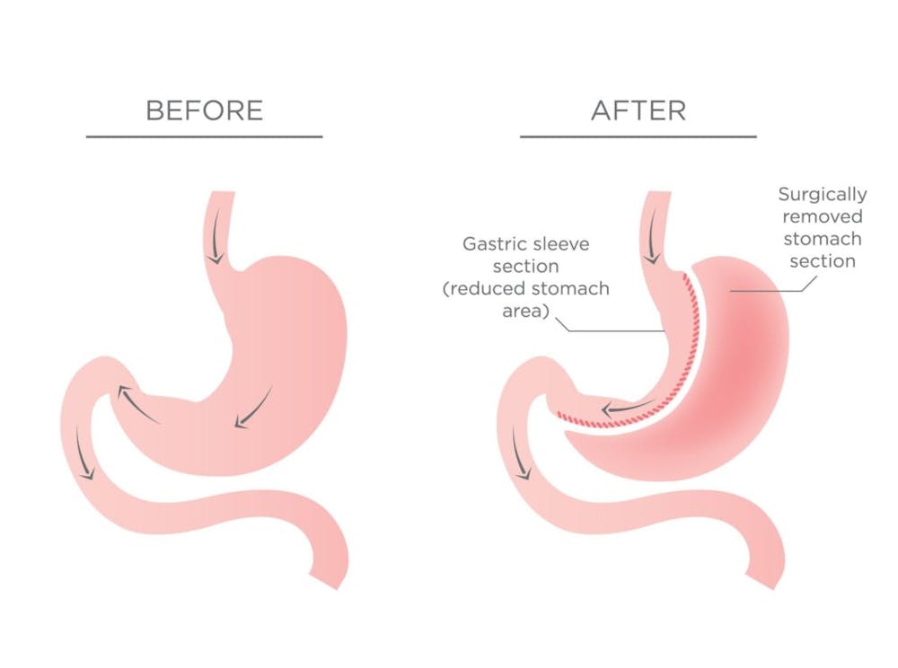 before and after gastric sleeve surgery