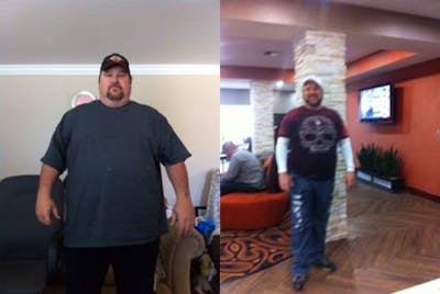 Bariatric Surgery Before & After Gallery - Patient 204170 - Image 1