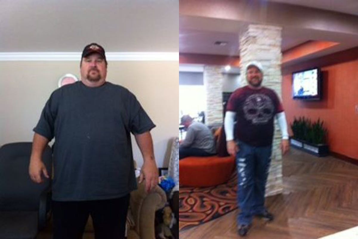 Bariatric Surgery Before & After Gallery - Patient 204170 - Image 1