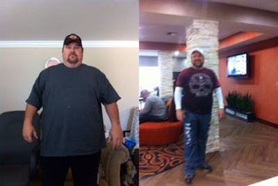 Bariatric Surgery Before & After Gallery - Patient 204170 - Image 1