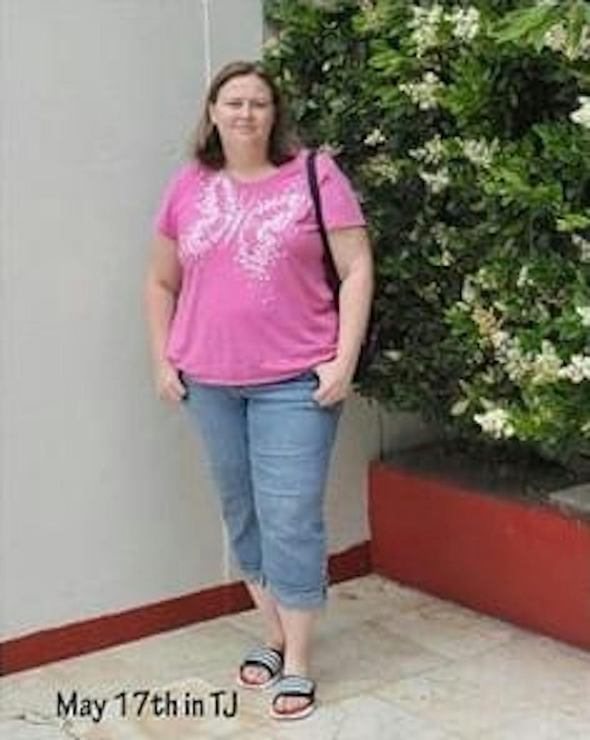 Bariatric Surgery Before & After Gallery - Patient 480027 - Image 1