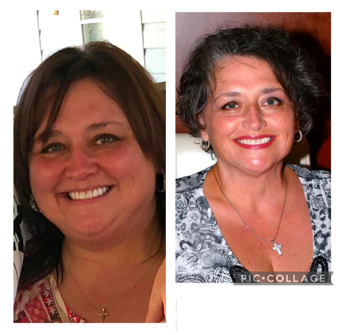Bariatric Surgery Before & After Gallery - Patient 137656 - Image 1