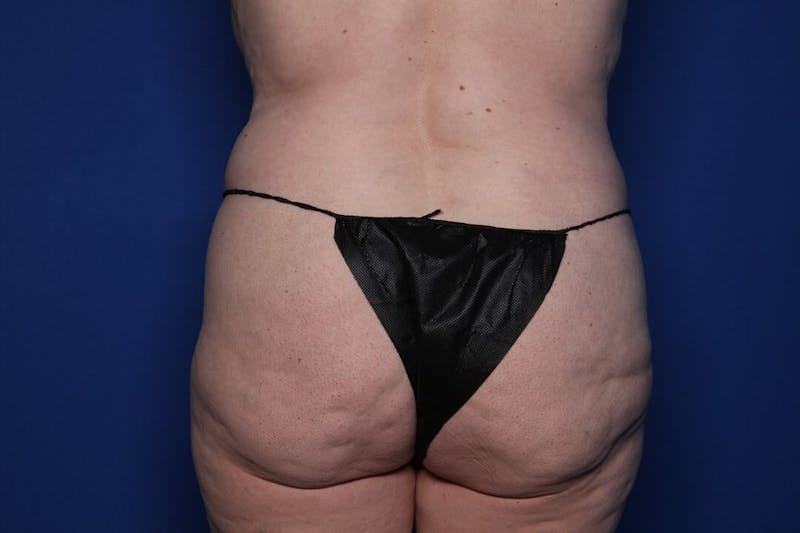 Tummy Tuck Before & After Gallery - Patient 192577 - Image 5