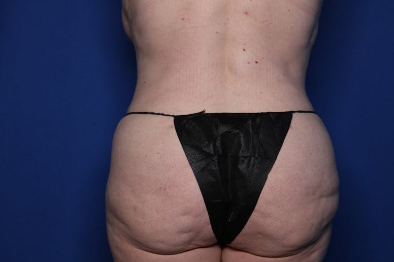 Tummy Tuck Before & After Gallery - Patient 192577 - Image 6