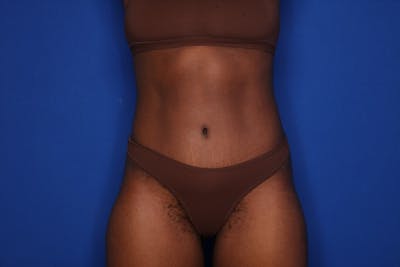 Tummy Tuck Before & After Gallery - Patient 115401 - Image 2