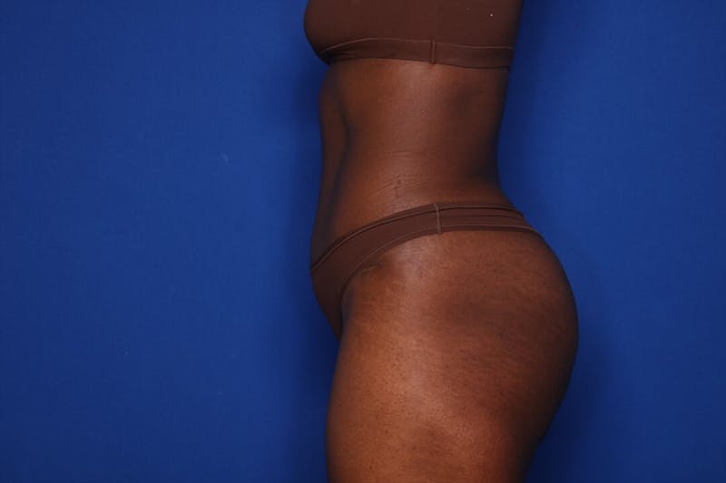 Tummy Tuck Before & After Gallery - Patient 115401 - Image 4