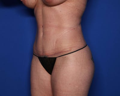 Tummy Tuck Before & After Gallery - Patient 289377 - Image 2