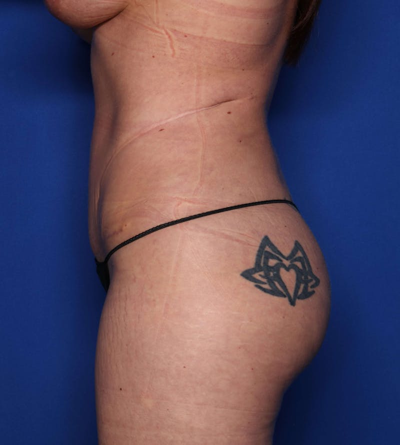 Tummy Tuck Before & After Gallery - Patient 289377 - Image 6