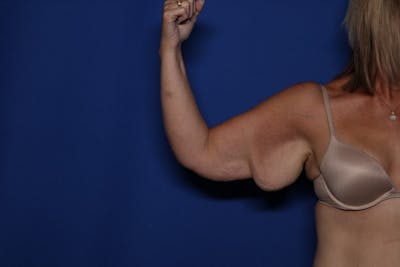 Arm Lift Before & After Gallery - Patient 257708 - Image 1