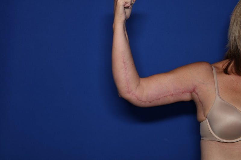 Arm Lift Before & After Gallery - Patient 257708 - Image 2