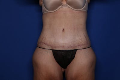 Body Lift Before & After Gallery - Patient 396153 - Image 2