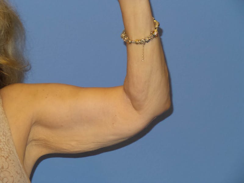 Arm Lift Before & After Gallery - Patient 220463 - Image 1