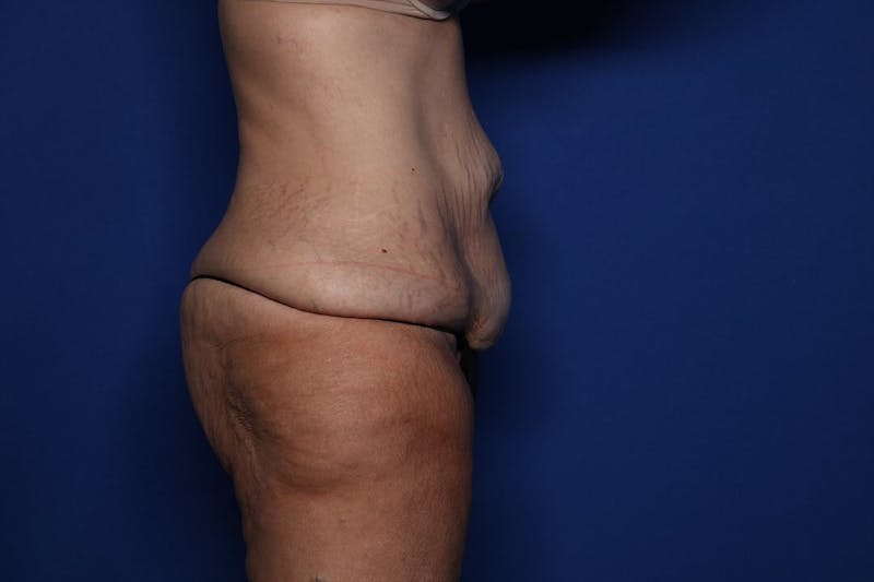 Body Lift Before & After Gallery - Patient 396153 - Image 3
