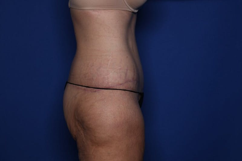 Body Lift Before & After Gallery - Patient 396153 - Image 4