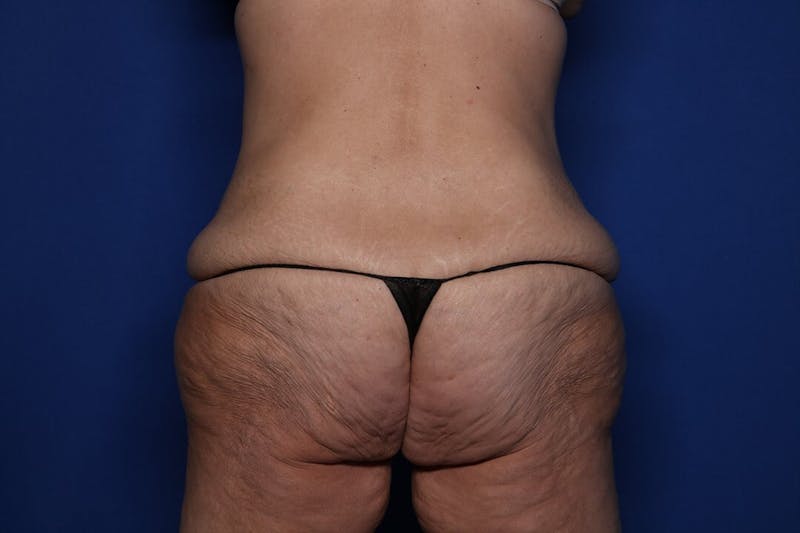 Body Lift Before & After Gallery - Patient 396153 - Image 5