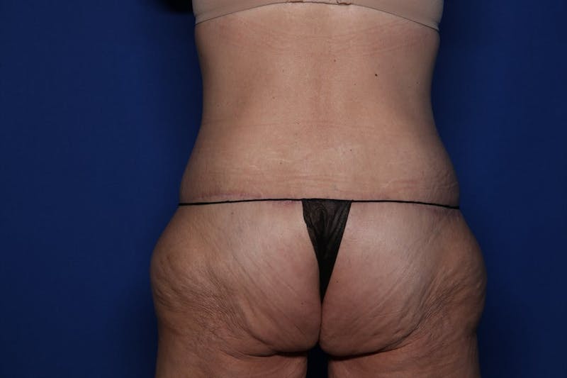 Body Lift Before & After Gallery - Patient 396153 - Image 6