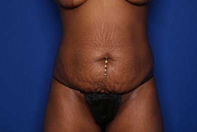 Tummy Tuck Before & After Gallery - Patient 307408 - Image 1