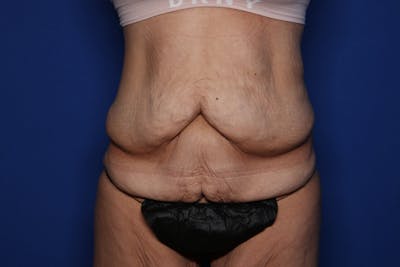 Body Lift Before & After Gallery - Patient 404665 - Image 1