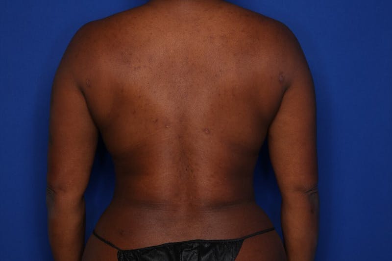 BodyTite™ Before & After Gallery - Patient 109695 - Image 4