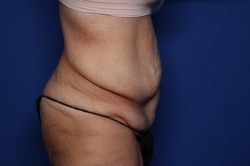 Body Lift Before & After Gallery - Patient 404665 - Image 3