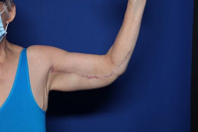 Arm Lift Before & After Gallery - Patient 261661 - Image 2