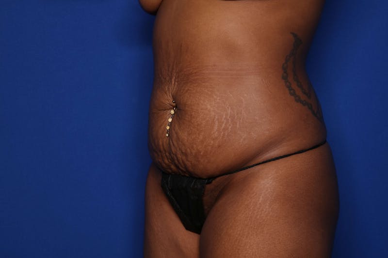 Tummy Tuck Before & After Gallery - Patient 307408 - Image 3