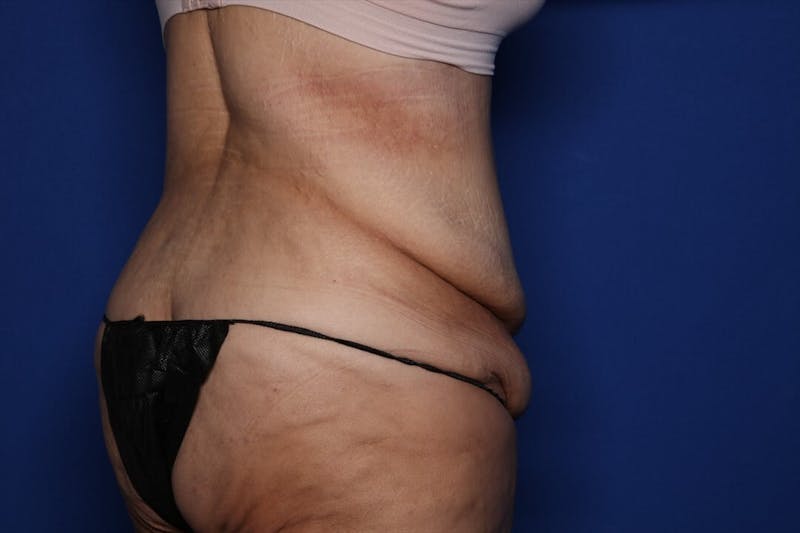 Body Lift Before & After Gallery - Patient 404665 - Image 7