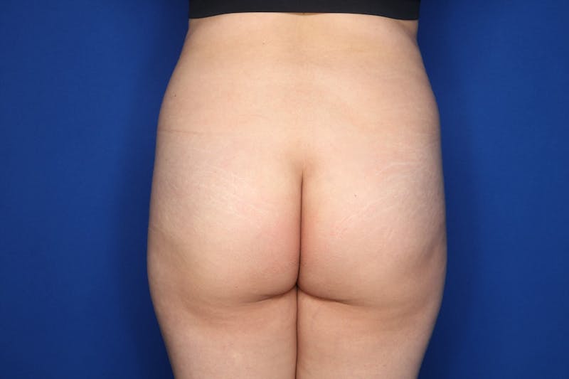 Brazilian Butt Lift Before & After Gallery - Patient 389407 - Image 1