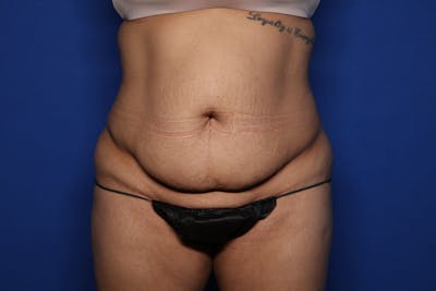 Tummy Tuck Before & After Gallery - Patient 369942 - Image 1