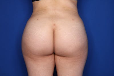 Brazilian Butt Lift Before & After Gallery - Patient 389407 - Image 2