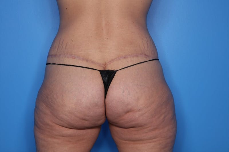 Body Lift Before & After Gallery - Patient 128454 - Image 4